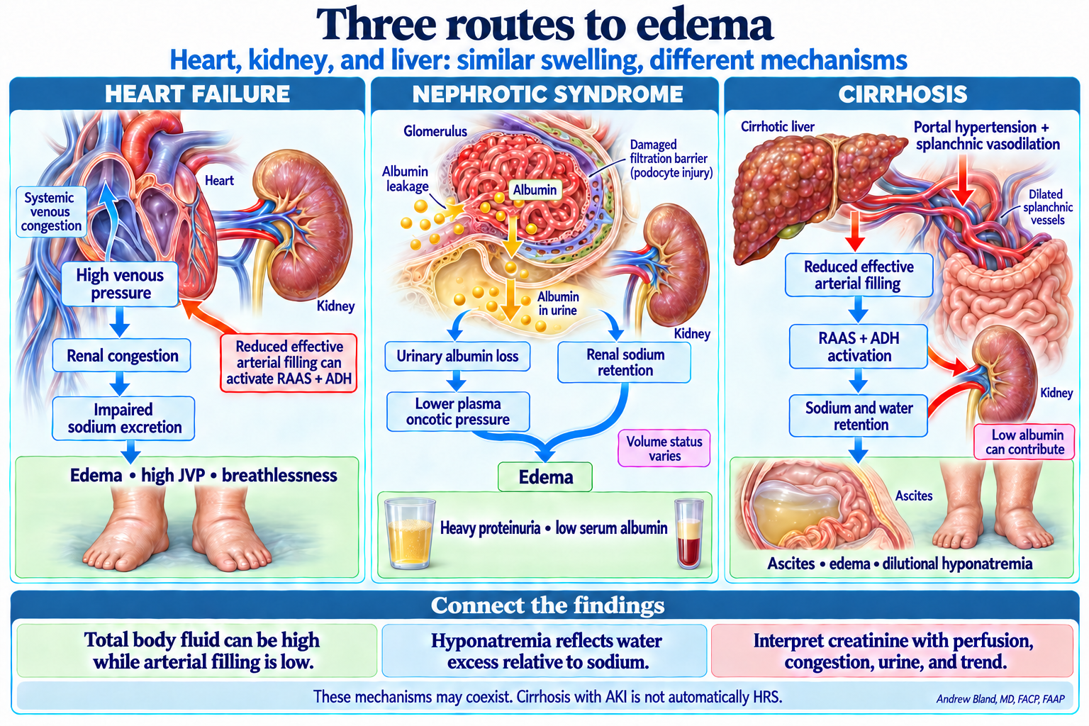 Heart failure: venous congestion impairs sodium excretion. Nephrotic syndrome: albumin loss and renal sodium retention contribute to edema. Cirrhosis: splanchnic vasodilation reduces effective arterial filling and activates sodium and water retention. These processes can overlap.