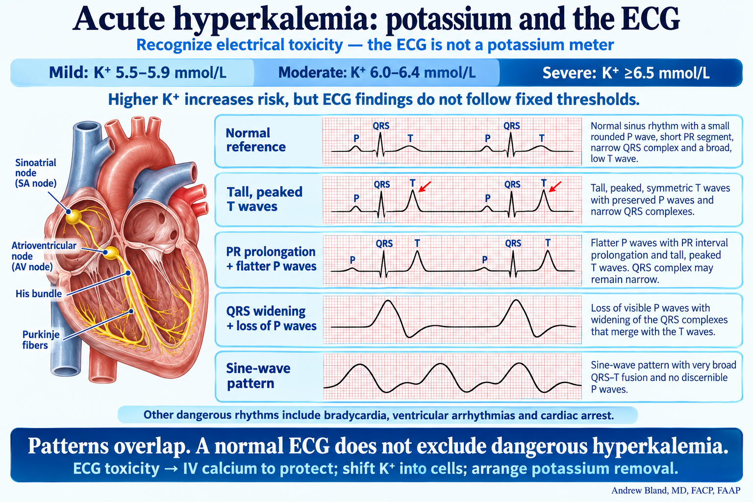 Potassium severity ranges are shown separately from ECG patterns: peaked T waves, PR prolongation, flatter or absent P waves, QRS widening and sine-wave fusion. A normal ECG does not exclude dangerous hyperkalemia.