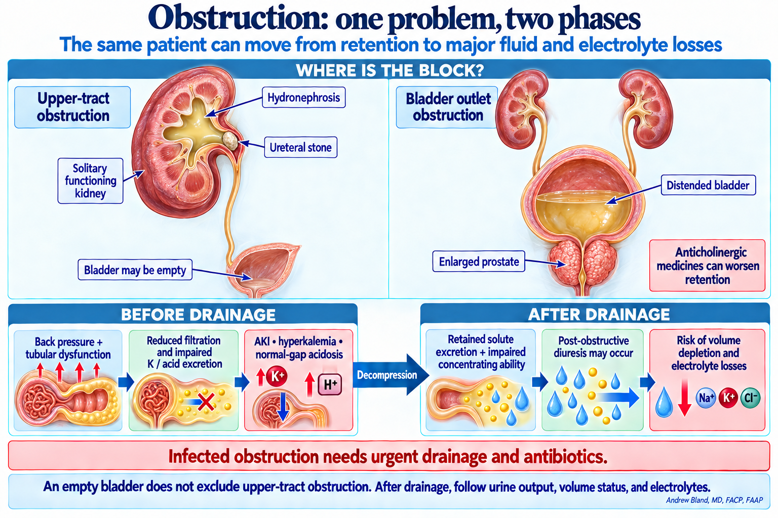 A ureteral stone in a solitary functioning kidney can cause severe AKI even when the bladder is empty. Bladder outlet obstruction from an enlarged prostate causes retention. Before drainage, reduced filtration and tubular dysfunction can impair potassium and acid excretion. After drainage, retained-solute excretion and impaired concentration can cause large urine losses.