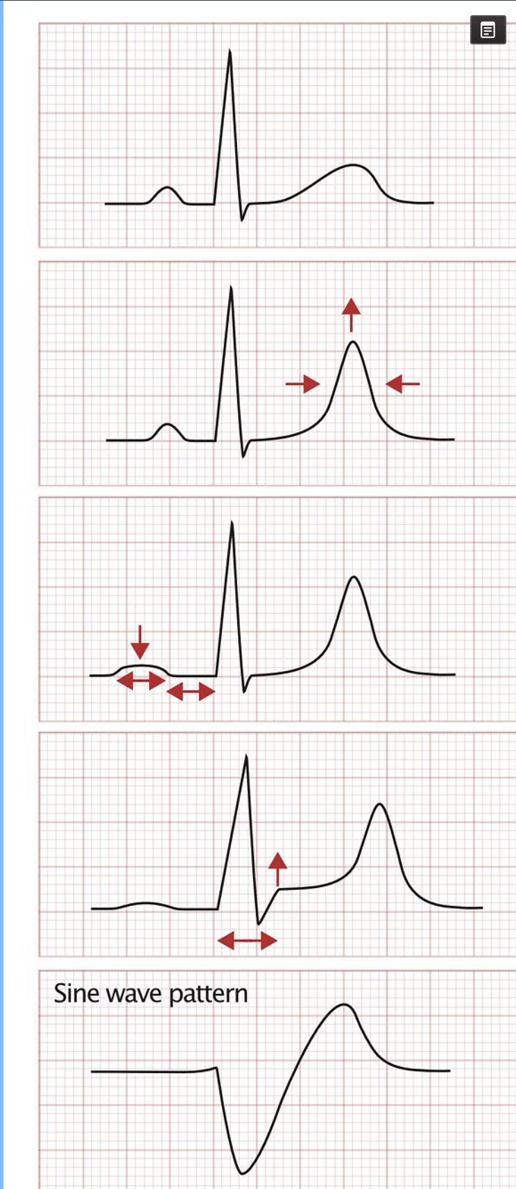 EKG Manifestations of Hyperkalemia by Potassium Level
