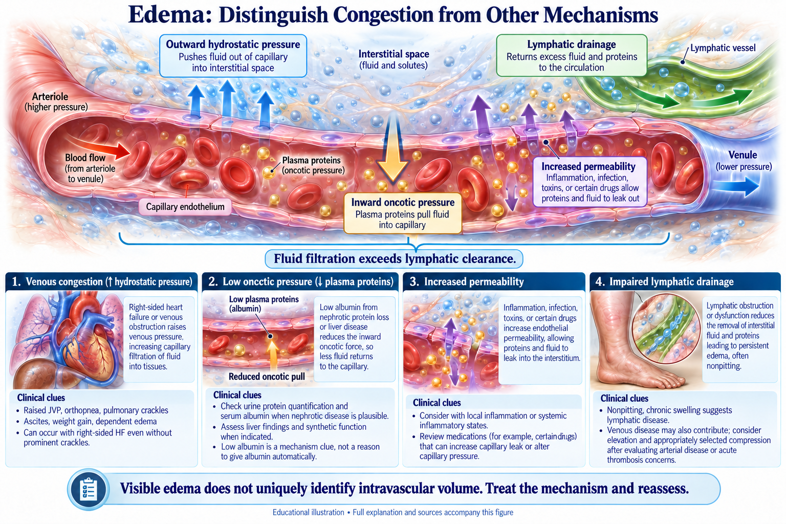 Edema: Identify the Force Moving Fluid visual summary