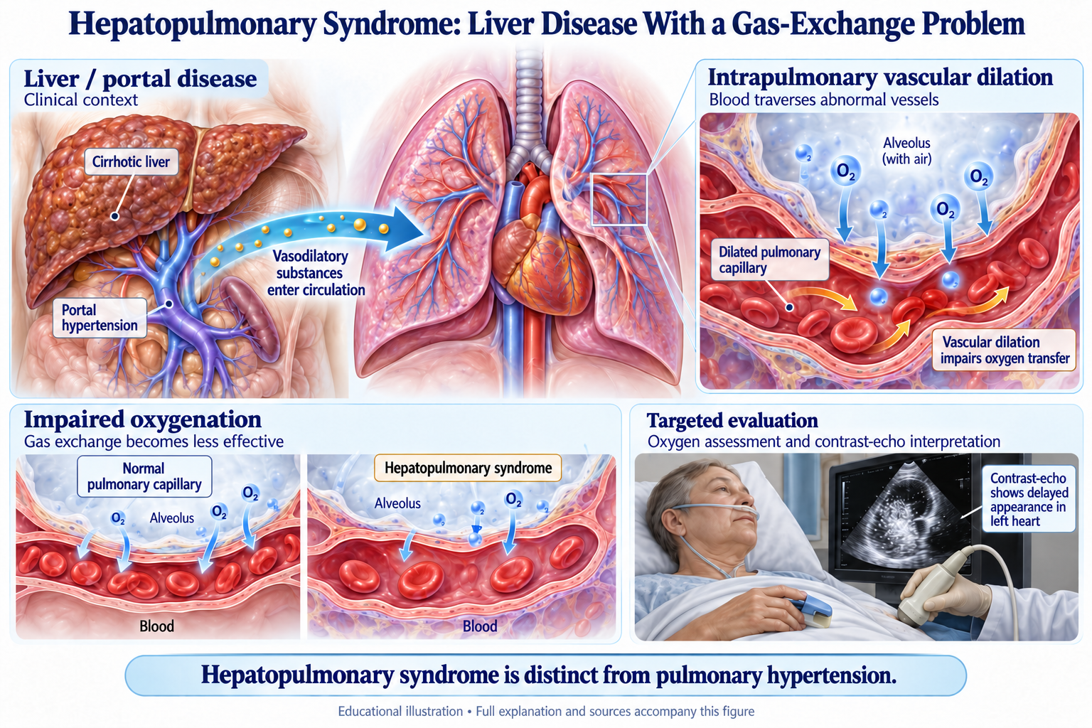 Hepatopulmonary Syndrome: Liver Disease With a Gas-Exchange Problem visual summary